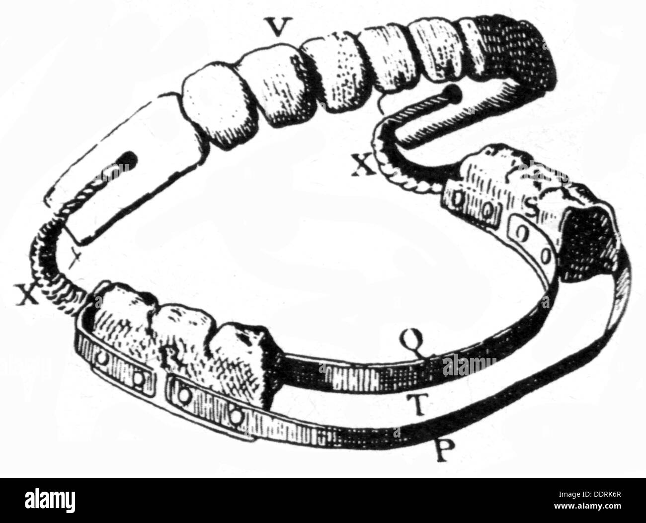 Medizin, Zahnmedizin, Prothese, hergestellt von Ambroise Pare (um 1510 - 1590), Zeichnung, 19. Jahrhundert, 16. Jahrhundert, 19. Jahrhundert, Zahn, Prothese, Prothesen, Zahnsatz, Zahnsätze, falsche Zähne, Zahnbrücke, Brücke, Brücken, Objekt, Objekte, Medizin, Medizin, künstliche Zähne, Prothesen, Teilprothese, voll, oben, unten, historisch, Zusätzliche-Rechte-Clearences-Nicht Verfügbar Stockfoto