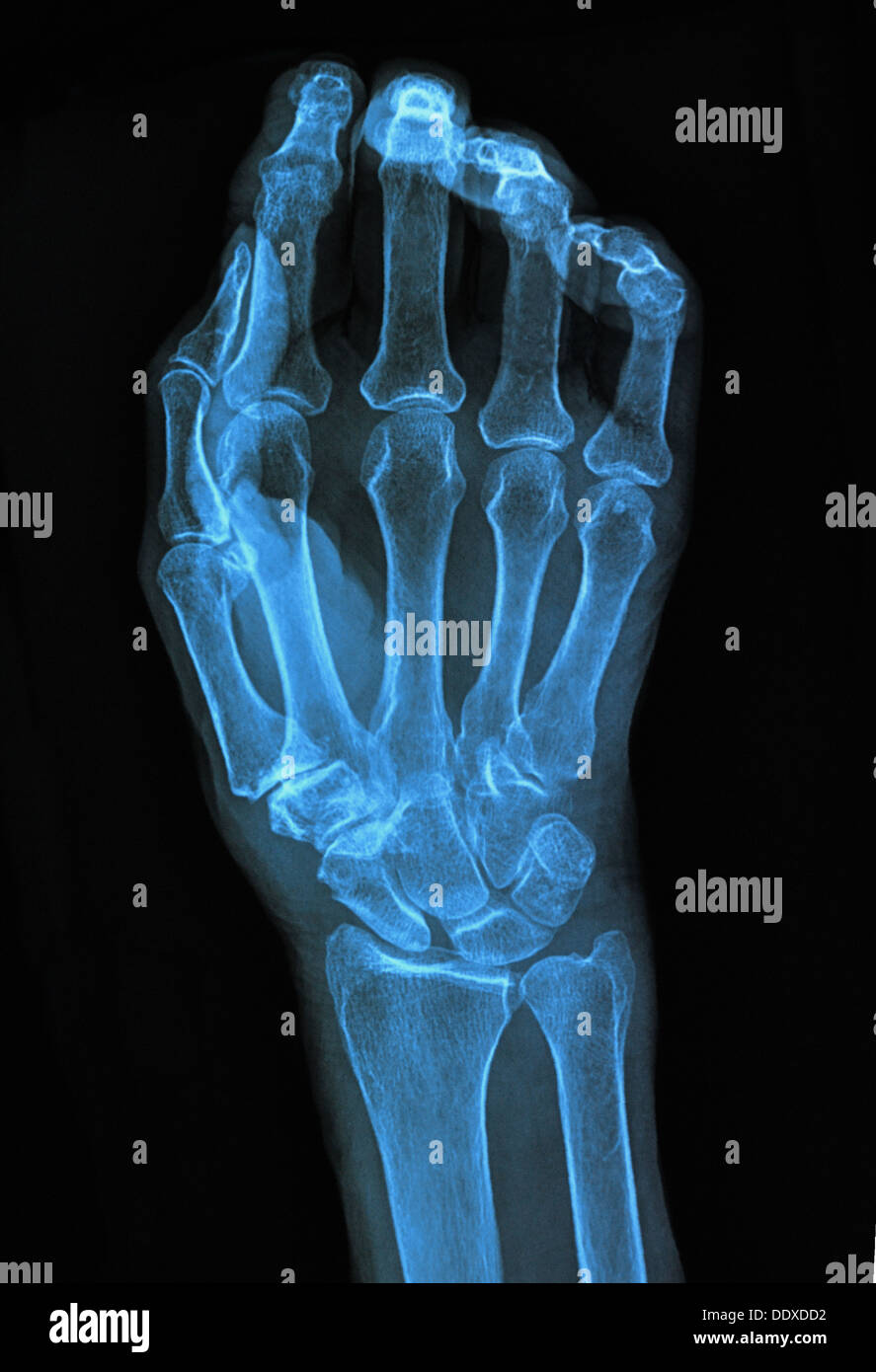 Medizinische-Bildhintergrund Hand xray Stockfoto