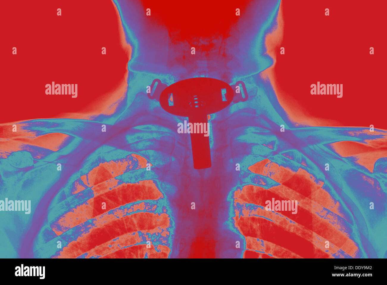 Tracheotomie -Fotos und -Bildmaterial in hoher Auflösung – Alamy