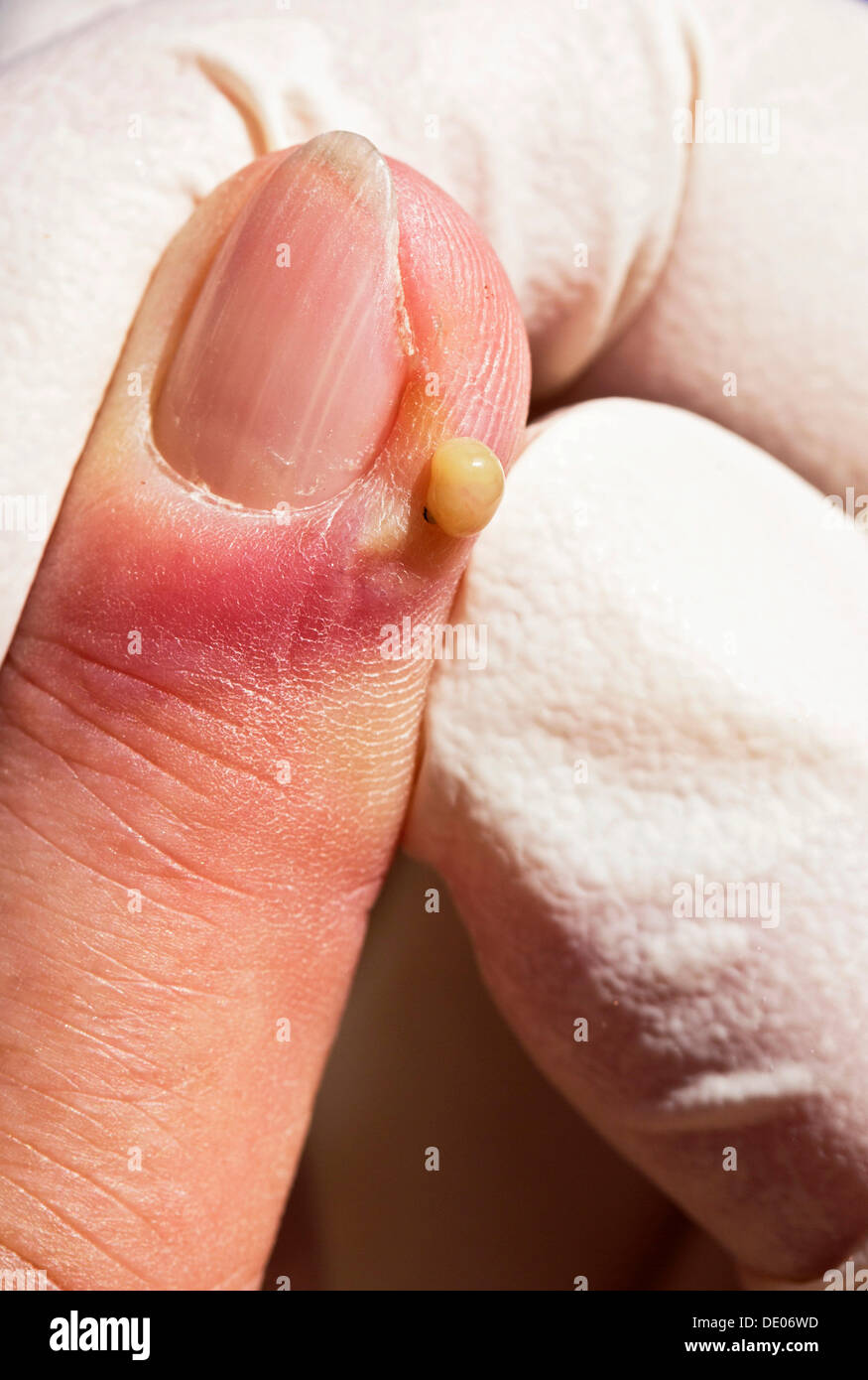 Bakterielle Infektion, Entzündung, Zeigefinger, Abszess, Eiter entfernen, OP-Handschuhe Stockfoto