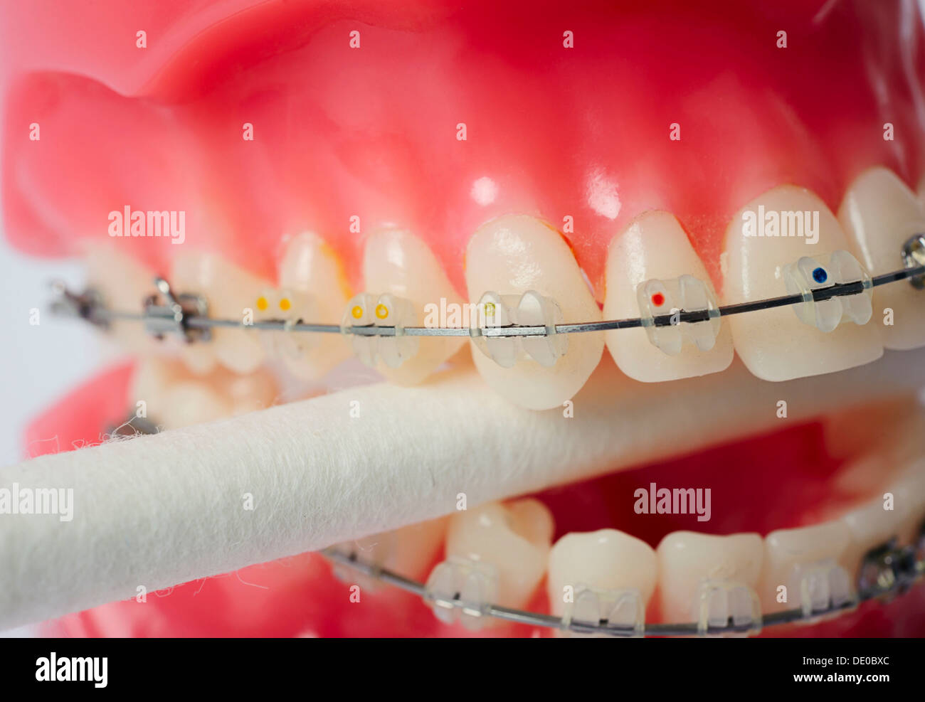 Zahnpflege, Zahnersatz mit festsitzenden Zahnspangen auf ein Wattestäbchen beißen Stockfoto