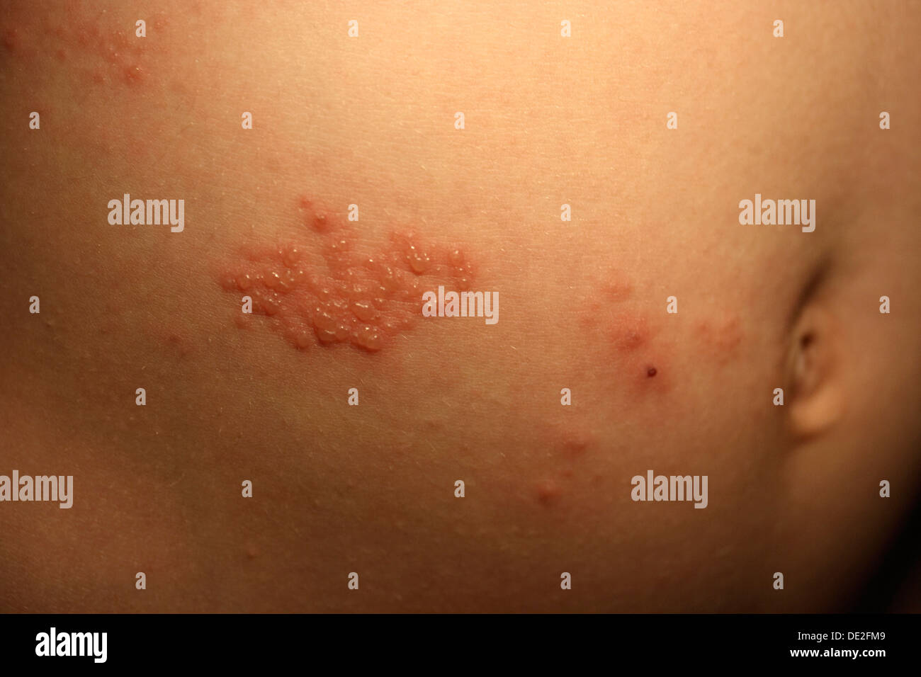 Herpes Zoster Stockfotos &amp; Herpes Zoster Bilder Alamy
