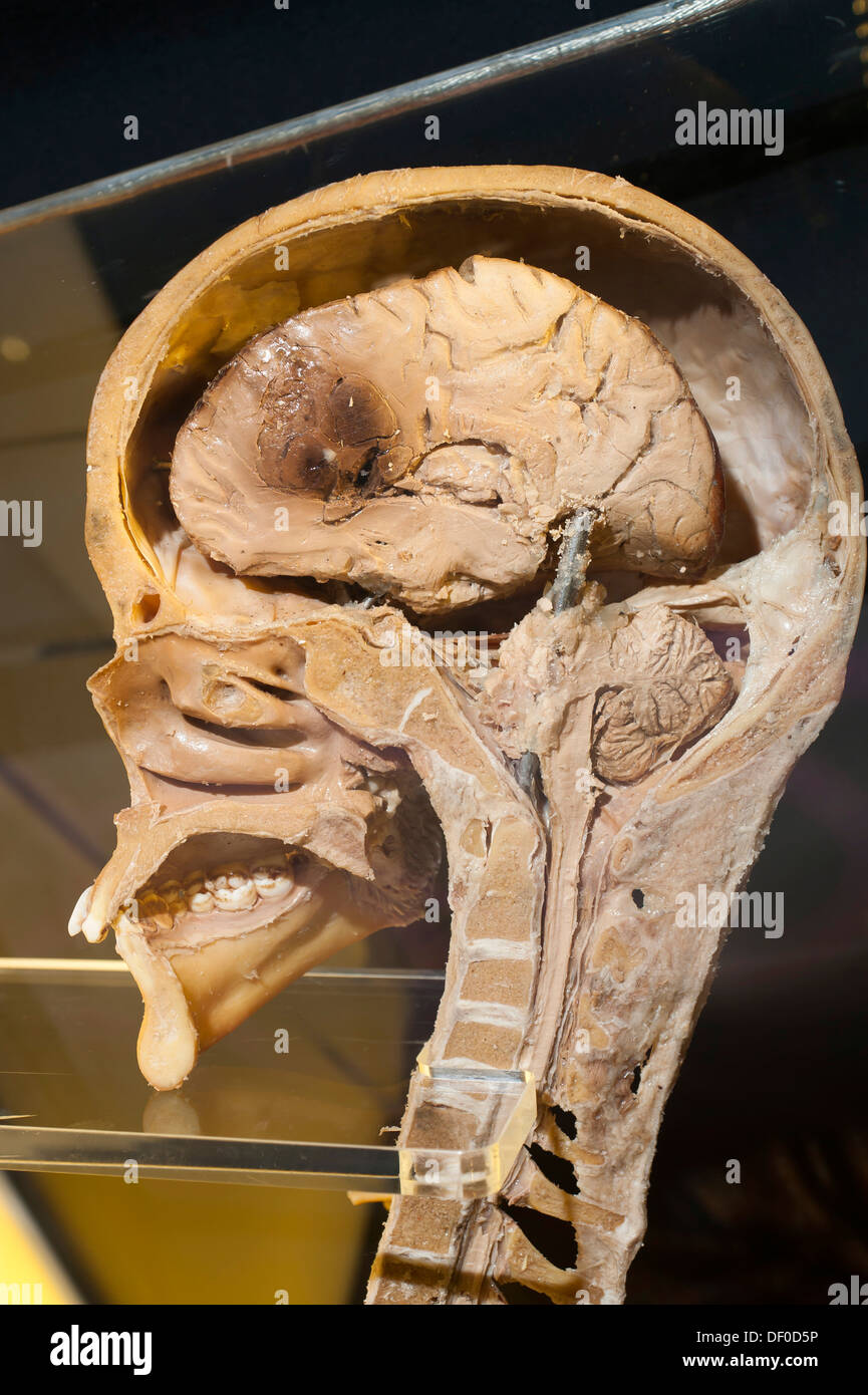 Plastination Exemplar Sagital Abschnitt von Kopf und Hals Stockfoto