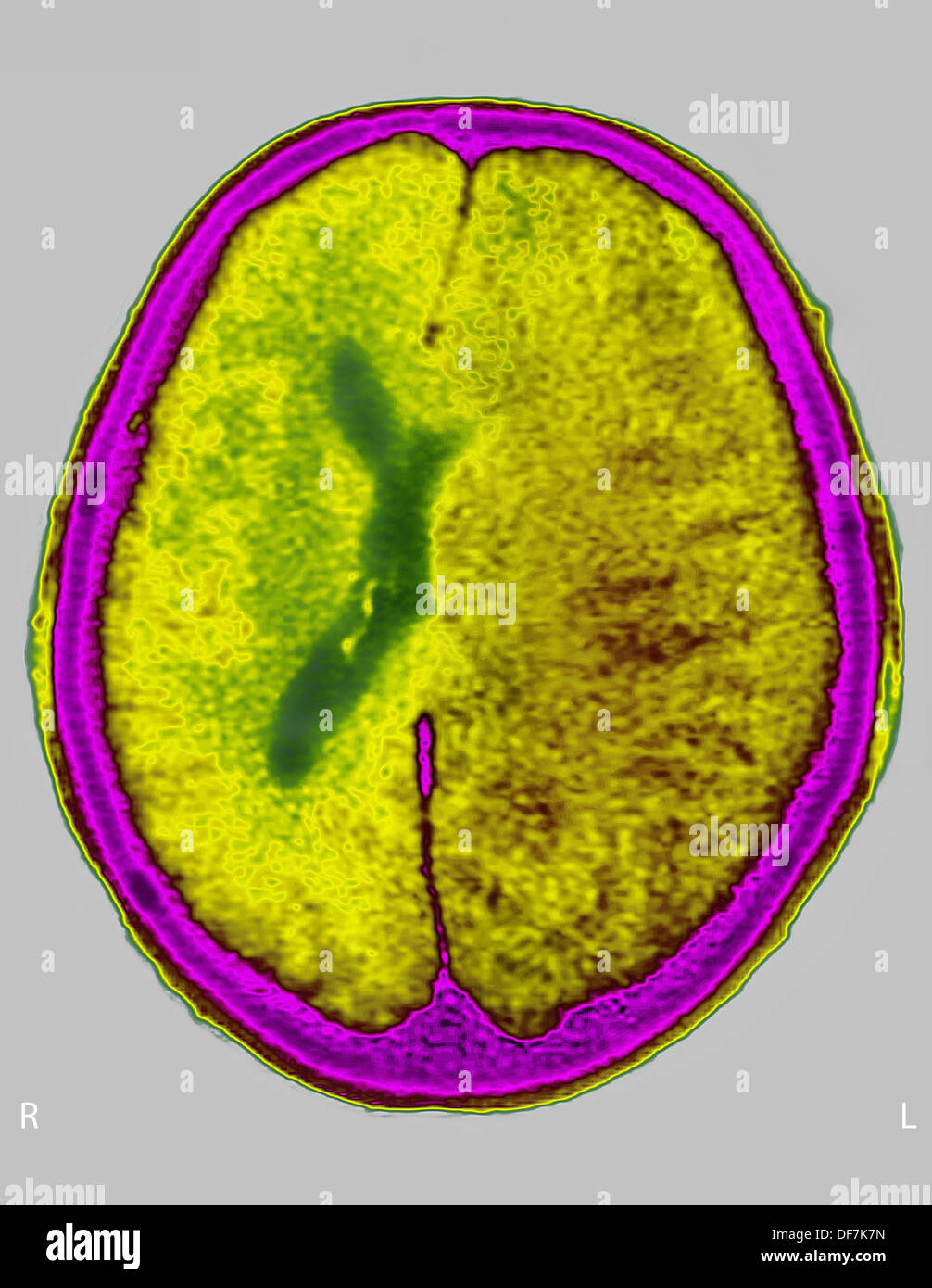 GEHIRN-ÖDEM CT-SCAN Stockfoto