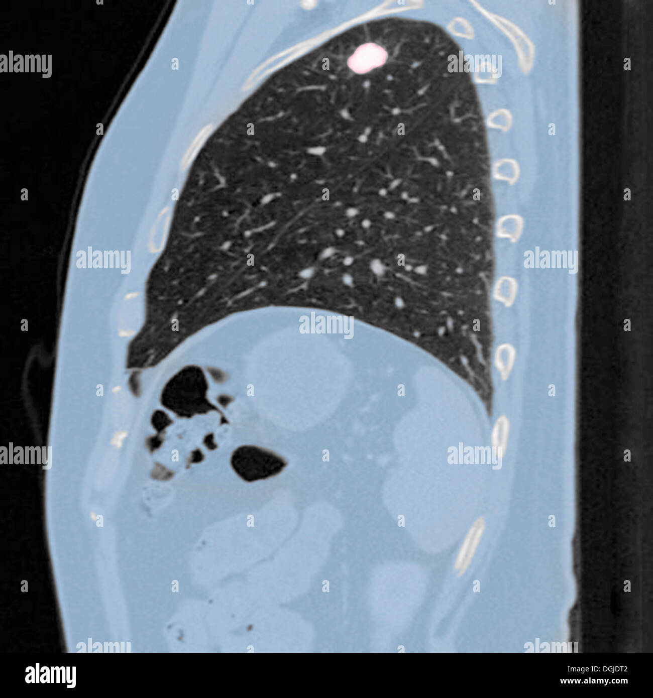Brust-CT-Untersuchung (Röntgen-Computertomographie) eines 54 Jahre alten männlichen Patienten. Tumor in der linken Oberlappens seiner Lunge zu sehen Stockfoto