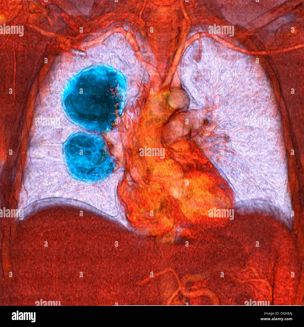 Metastasierendem Melanom der Lunge Stockfoto