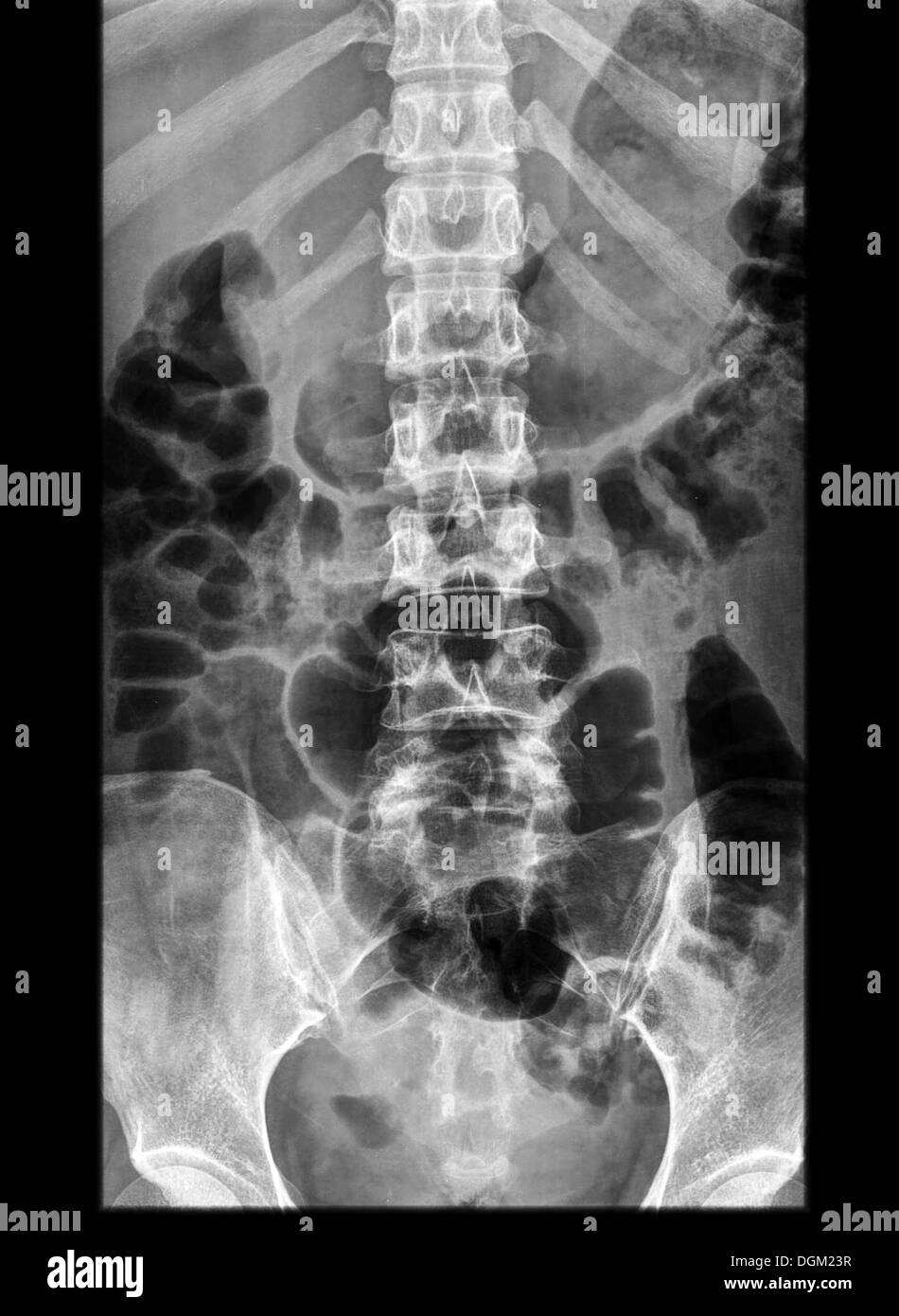 Röntgenstrahlung (komponiert von Röntgenstrahlen) ist eine Form von elektromagnetischer Strahlung Stockfoto