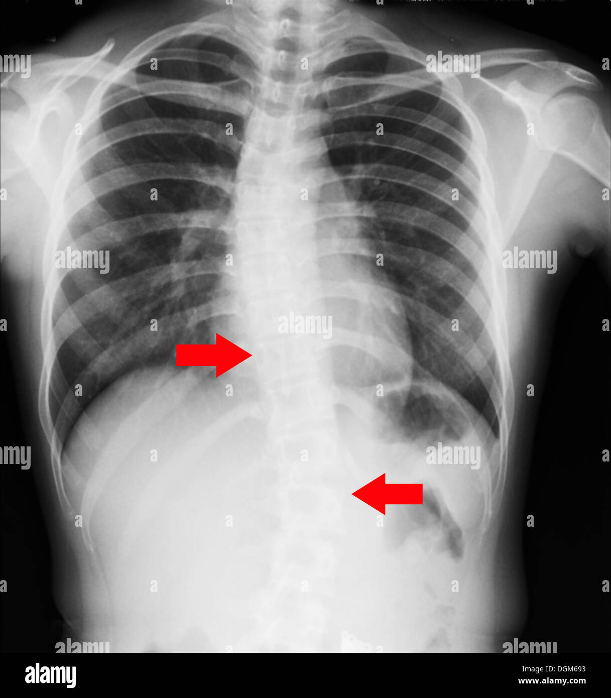 Röntgenstrahlung (komponiert von Röntgenstrahlen) ist eine Form von