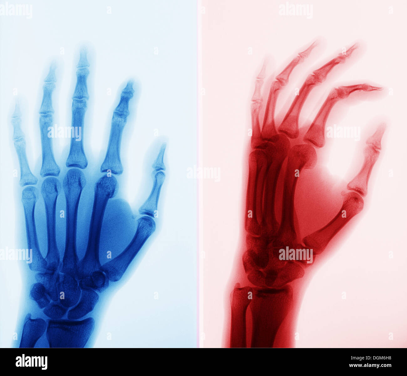 Röntgenstrahlung (komponiert von Röntgenstrahlen) ist eine Form von elektromagnetischer Strahlung Stockfoto
