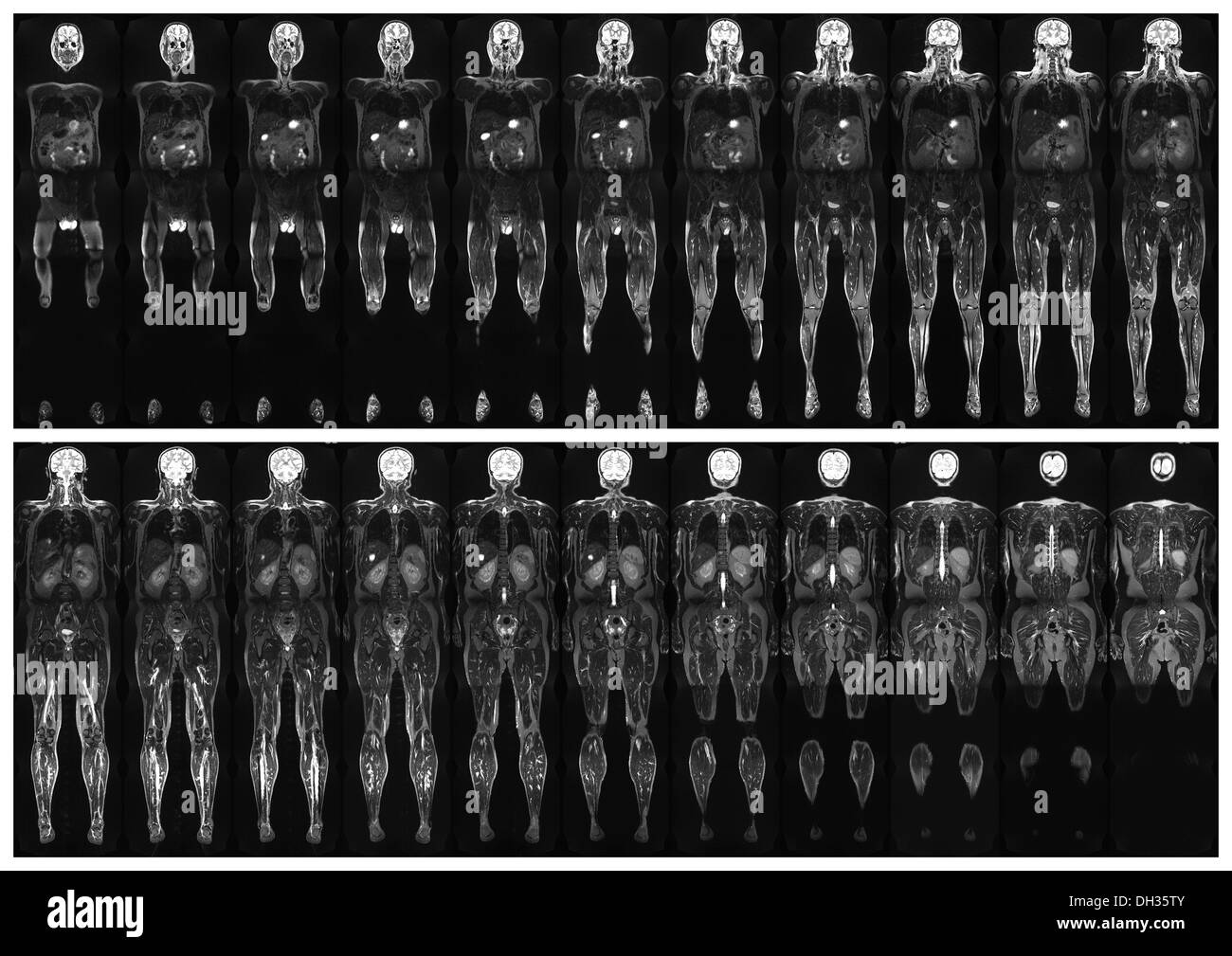 Komplette real MRT-Untersuchung des menschlichen Körpers, von der Vorder- und Rückseite Stockfoto