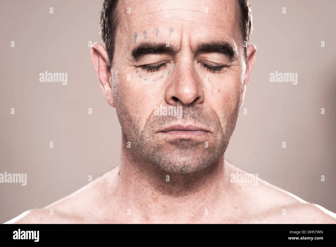 Mann mit Markierungen für plastische Chirurgie auf seinem Gesicht, Mannheim, Baden-Württemberg, Deutschland Stockfoto