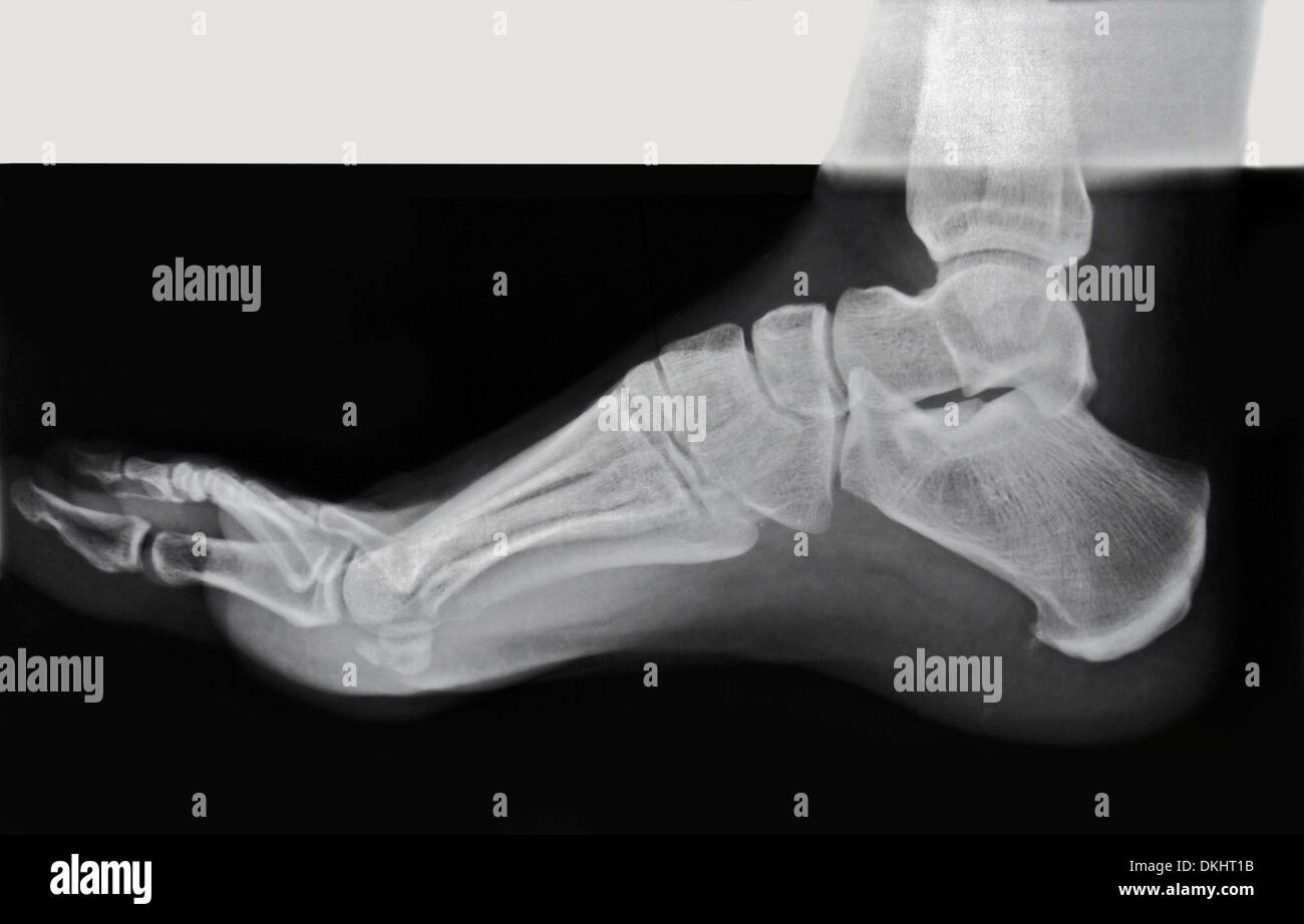Seitenansicht von einem Erwachsenen Fuß in eine Röntgenaufnahme. Stockfoto