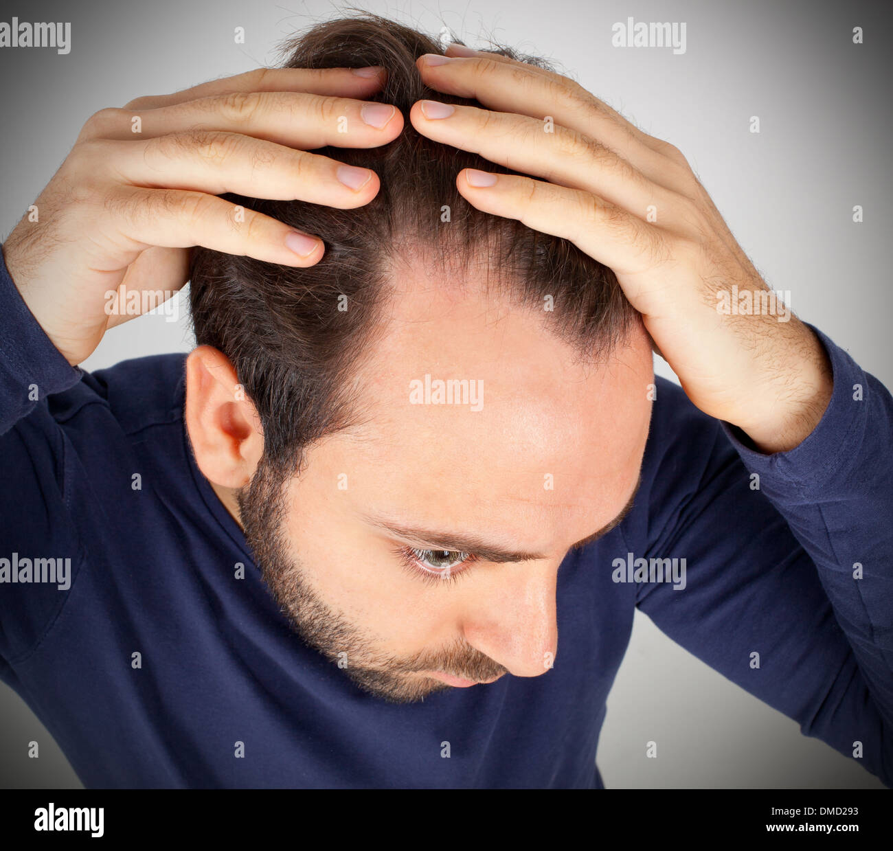 Kaukasischen Jüngling steuert Haarausfall Stockfoto