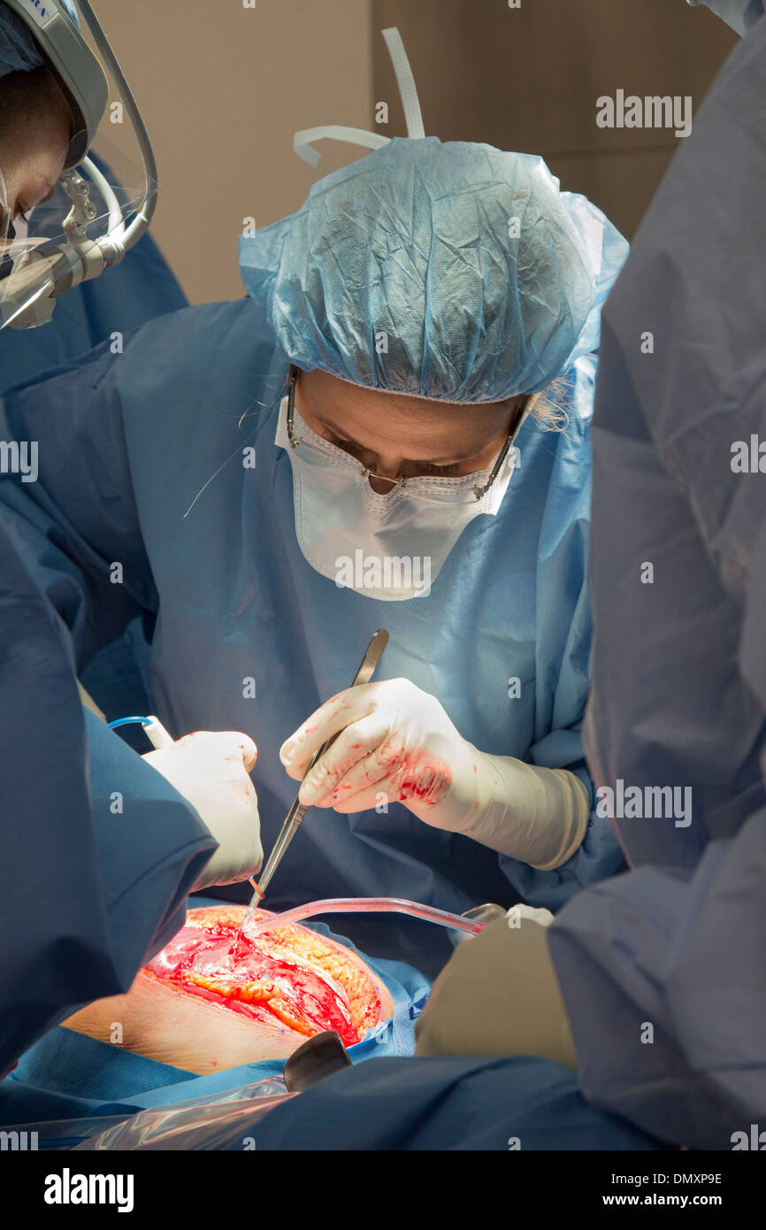 Chirurgen führen eine Hysterektomie auf eine Frau mit Endometriumkarzinom. Stockfoto