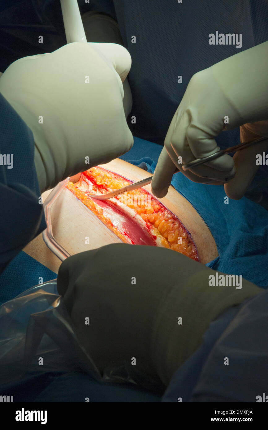 Chirurgen führen eine Hysterektomie auf eine Frau mit Endometriumkarzinom. Stockfoto