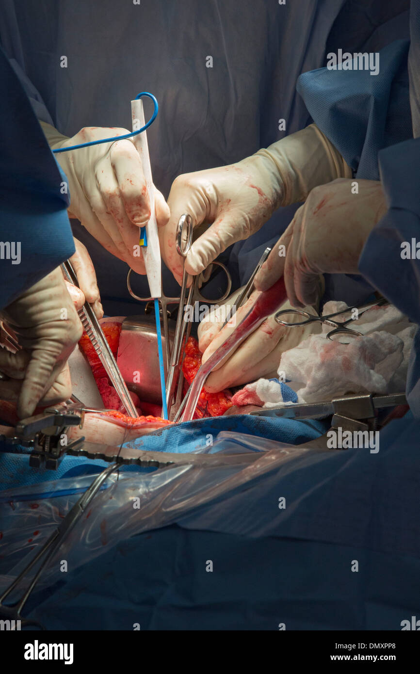 Chirurgen führen eine Hysterektomie auf eine Frau mit Endometriumkarzinom. Stockfoto