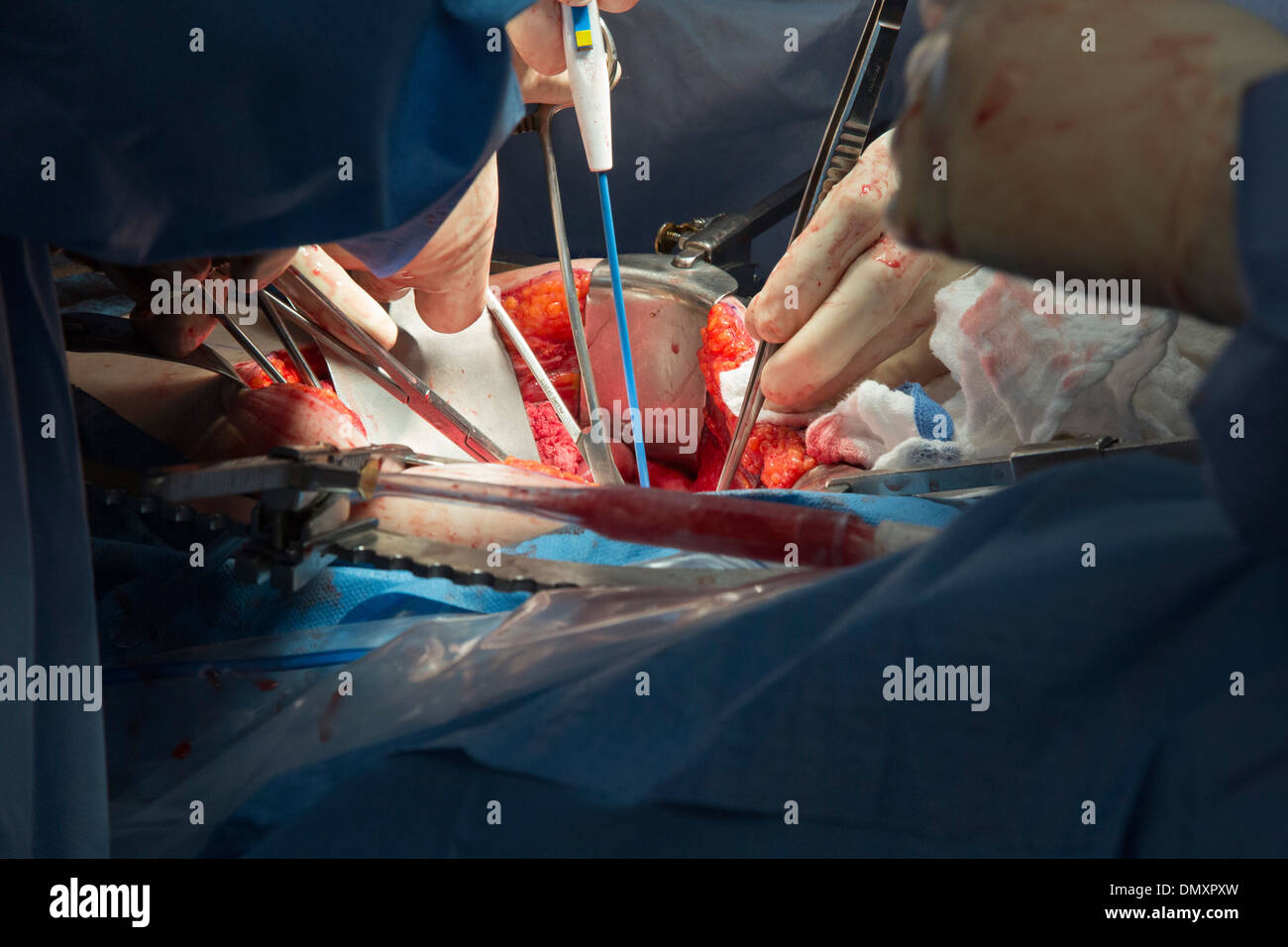 Chirurgen führen eine Hysterektomie auf eine Frau mit Endometriumkarzinom. Stockfoto