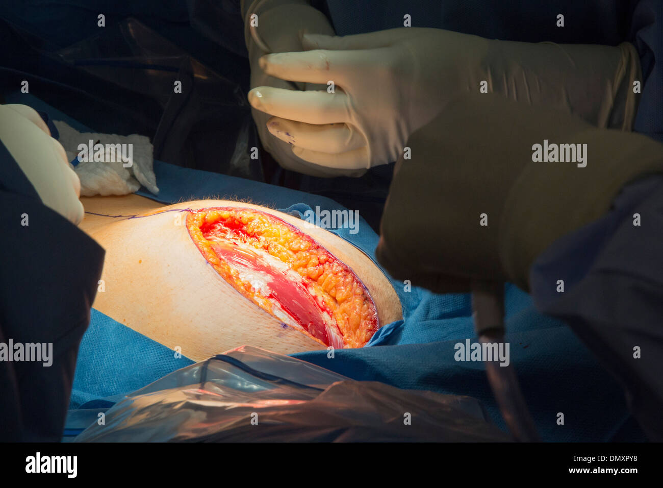 Chirurgen führen eine Hysterektomie auf eine Frau mit Endometriumkarzinom. Stockfoto