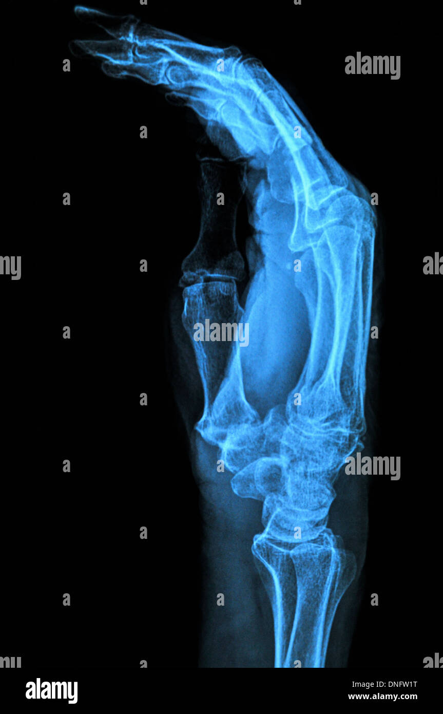 Medizinische-Bildhintergrund Hand xray Stockfoto