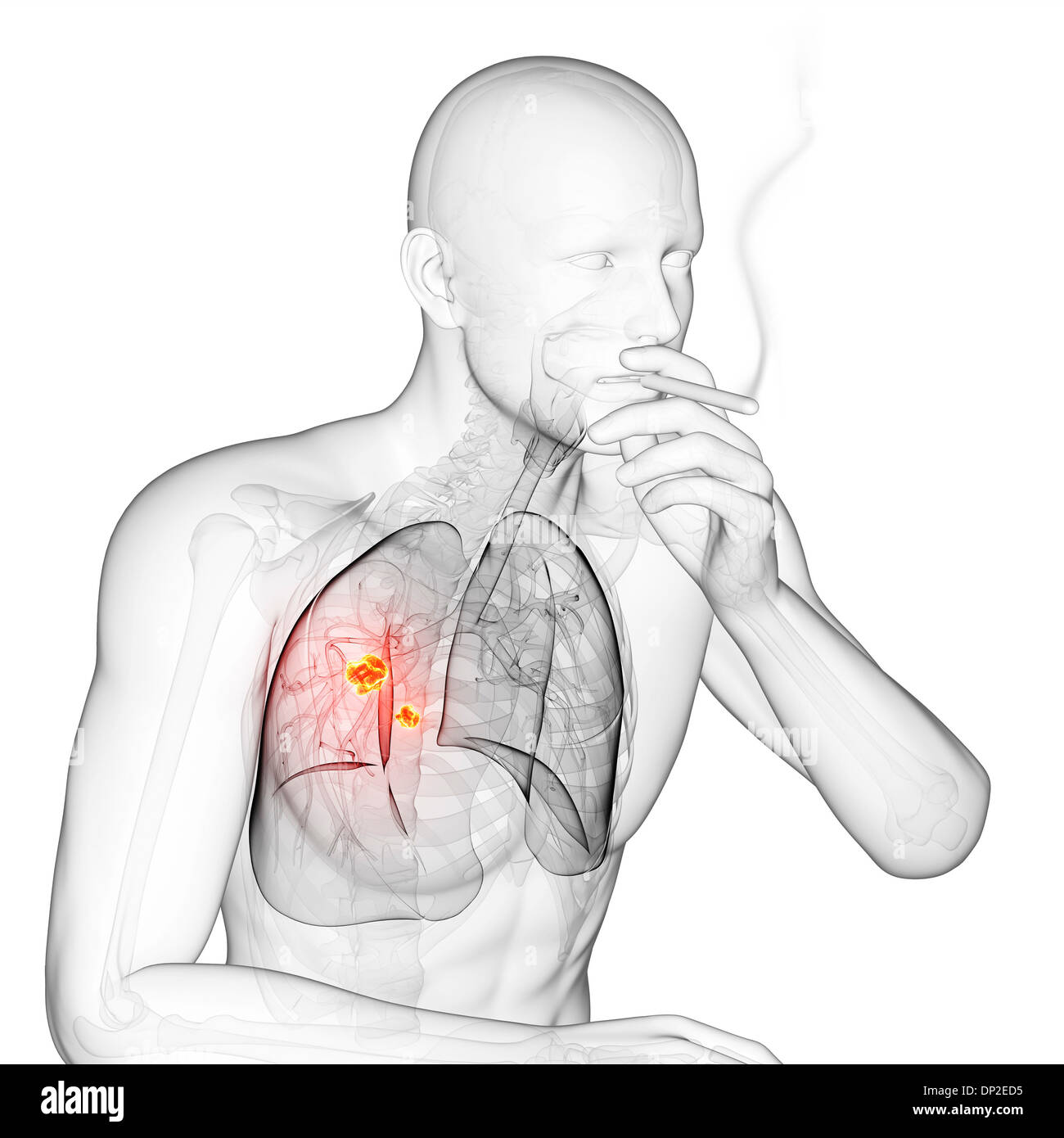 Lungenkrebs durch Rauchen, Kunstwerk Stockfotografie - Alamy