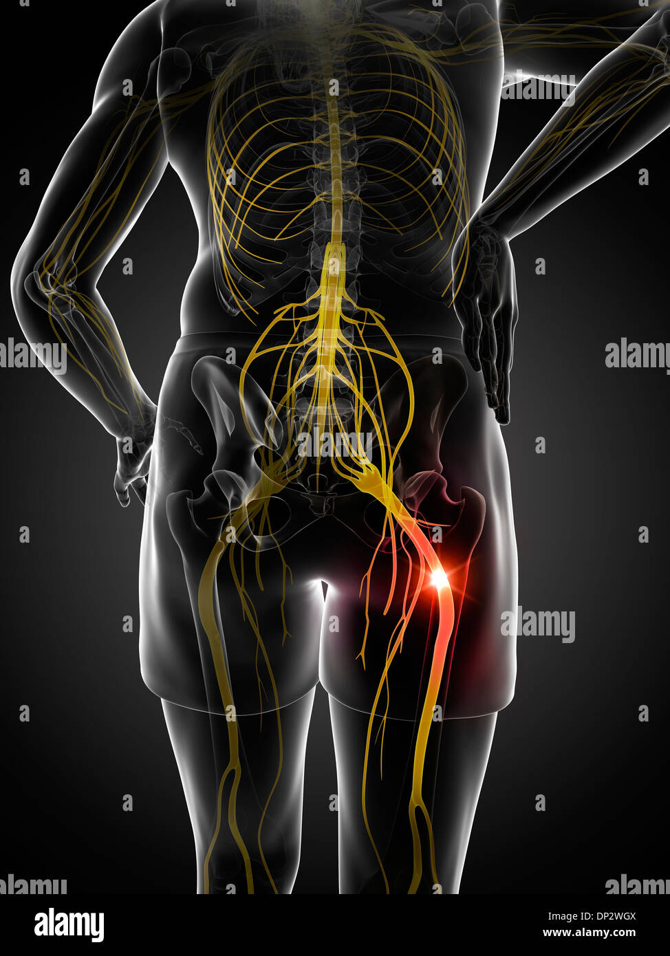 Schmerzhafte Ischiasnerv, artwork Stockfoto
