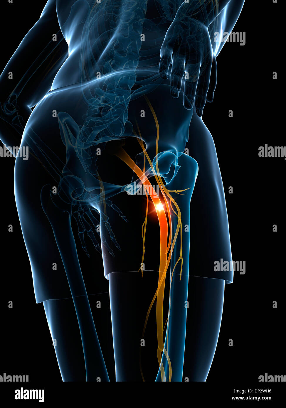 Schmerzhafte Ischiasnerv, artwork Stockfoto
