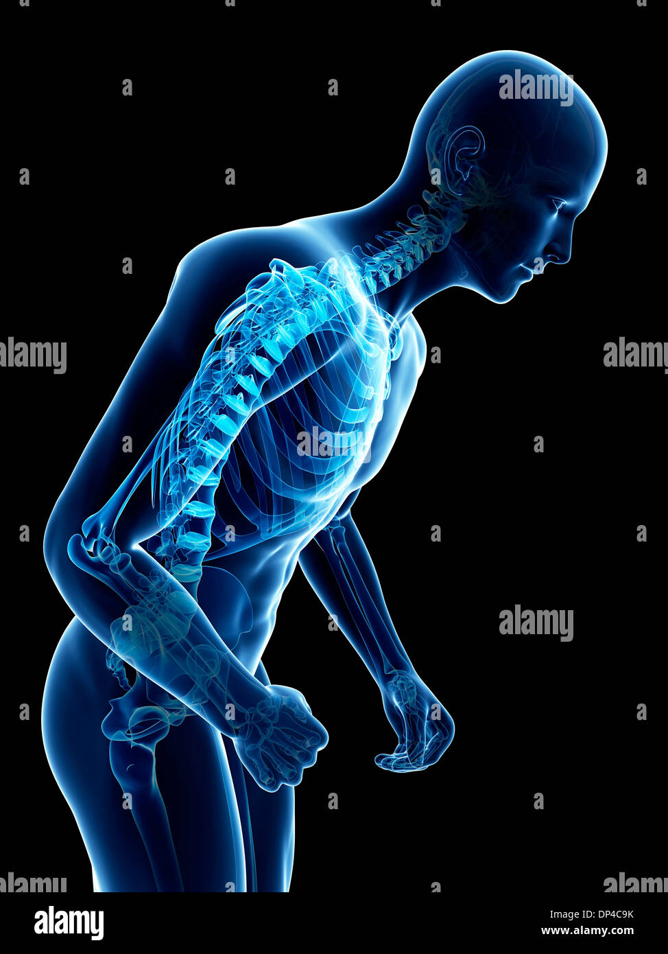 Parkinson-Krankheit, konzeptuellen Kunstwerk Stockfoto