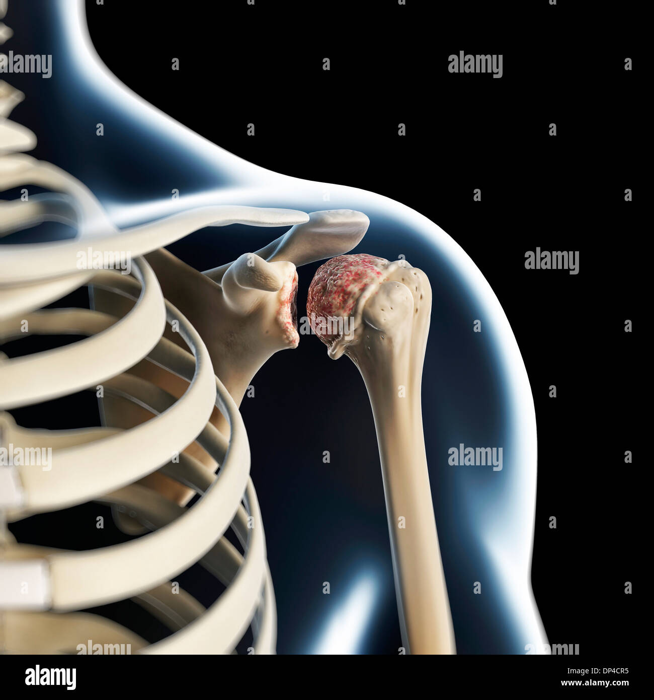 Arthritische Schulter, artwork Stockfoto