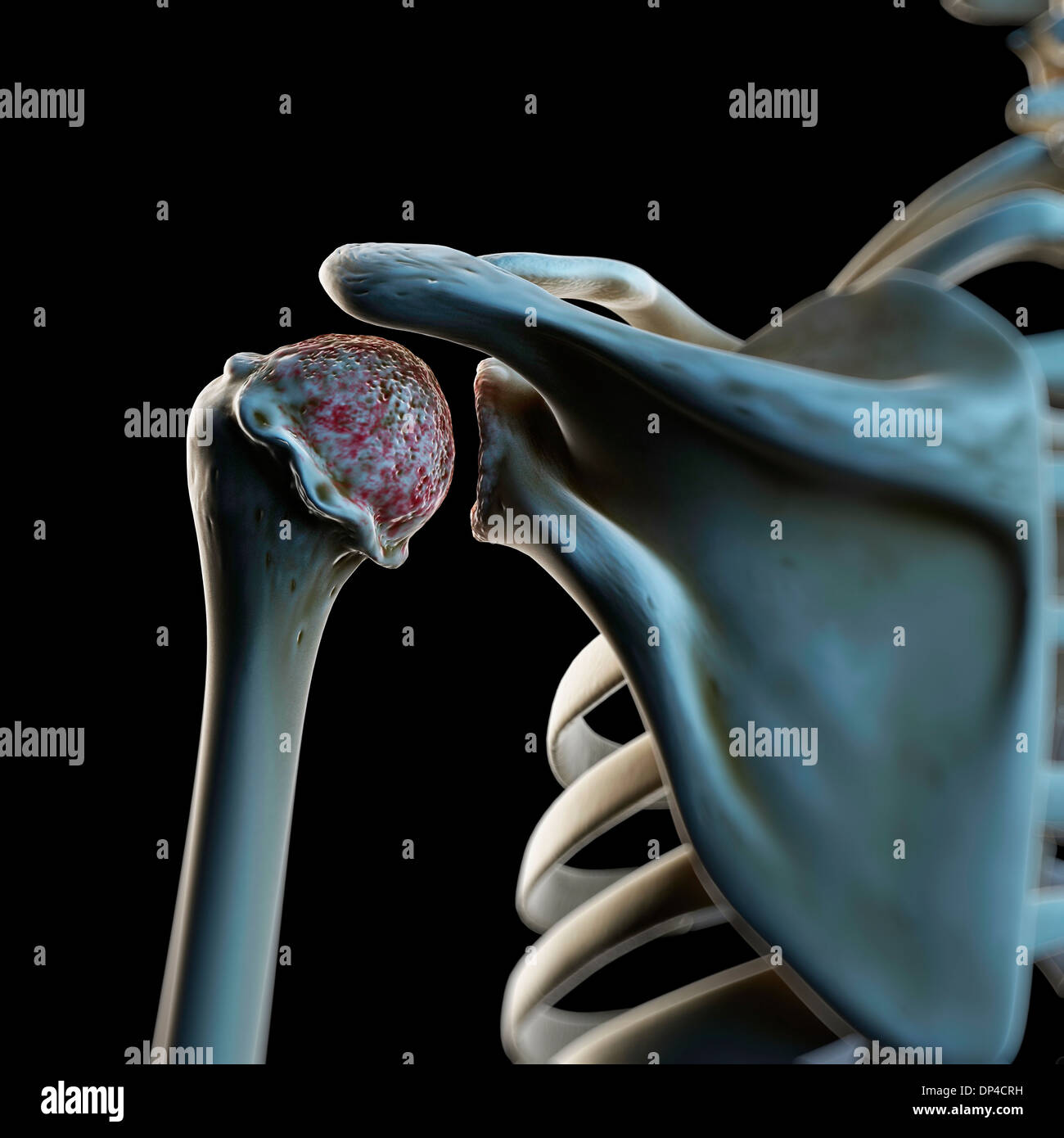 Arthritische Schulter, artwork Stockfoto