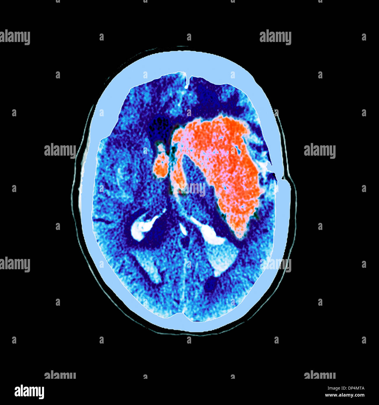 Hirnblutung, MRT-Untersuchung Stockfoto