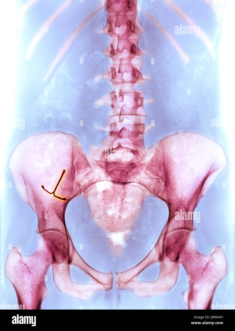 Ektopische IUD Verhütungsmittel, x-ray Stockfoto