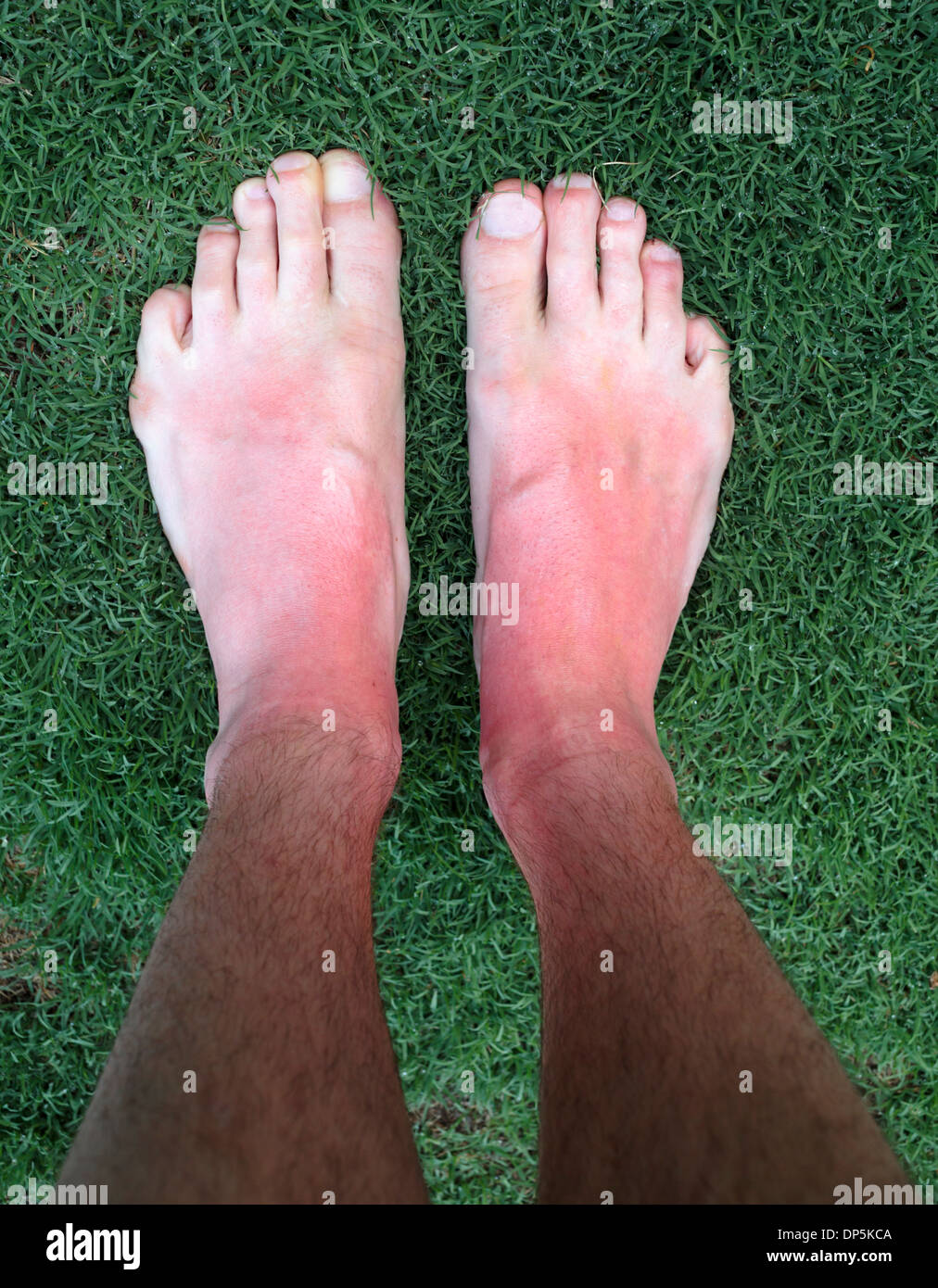 Sunburned feet Fotos und Bildmaterial in hoher Auflösung Alamy