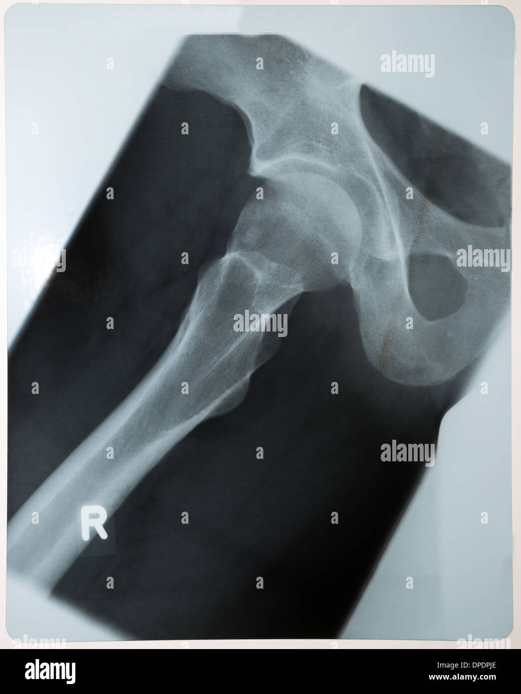 Radiologie-Röntgenaufnahme der menschlichen Hüfte Stockfoto