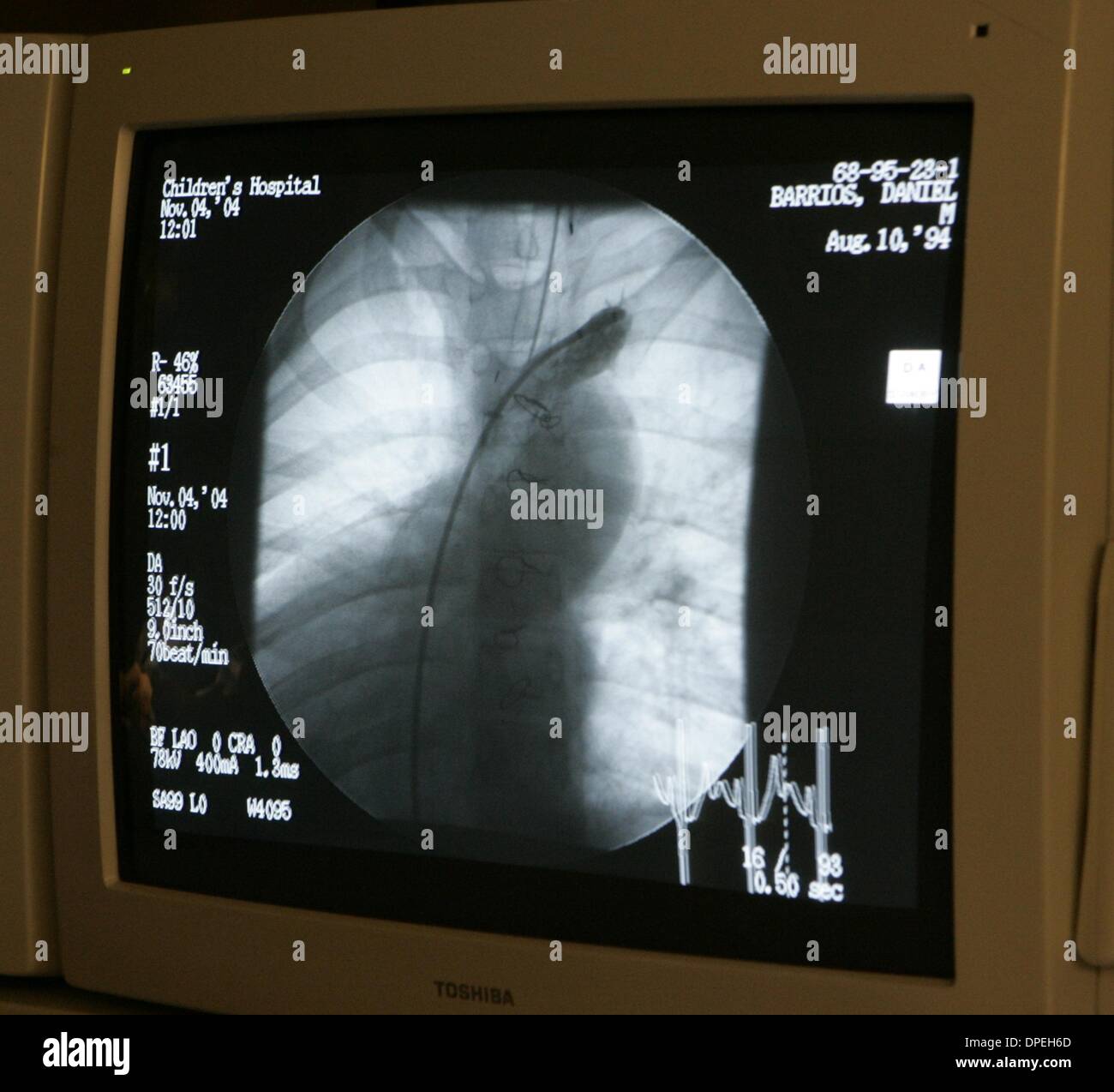 (Veröffentlicht am 06.11.2004, b-7:2) Ein Monitor neben einem Operationstisch bei Childrens Hospital zeigt ein Angiogramm einer 10 jährigen Herzens, als Ärzte das Blut sah fließen in die Lungenarterien. UT/DON KOHLBAUER Stockfoto