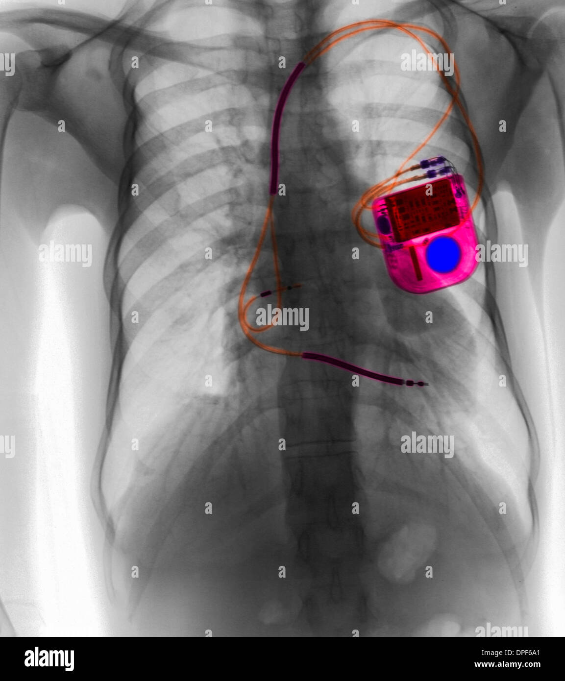 Brust Röntgen zeigt Herzschrittmacher Stockfoto