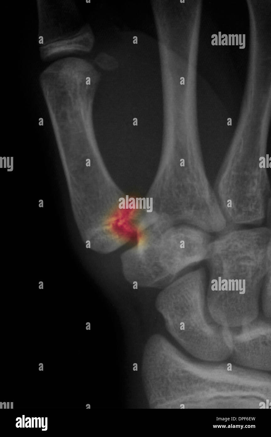 X-ray zeigt Mittelhandknochen Fraktur an der Basis des Daumens Stockfoto