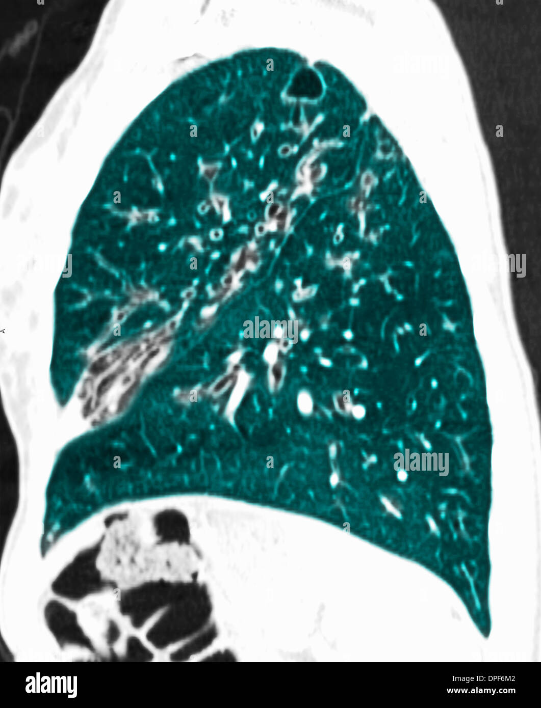 CT-Scan der Brust zeigt zystische Fibrose Stockfoto
