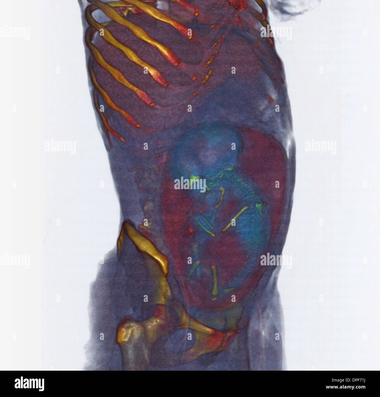 CT-Scan des Bauches zeigt 36 Wochen alten Fötus Stockfoto