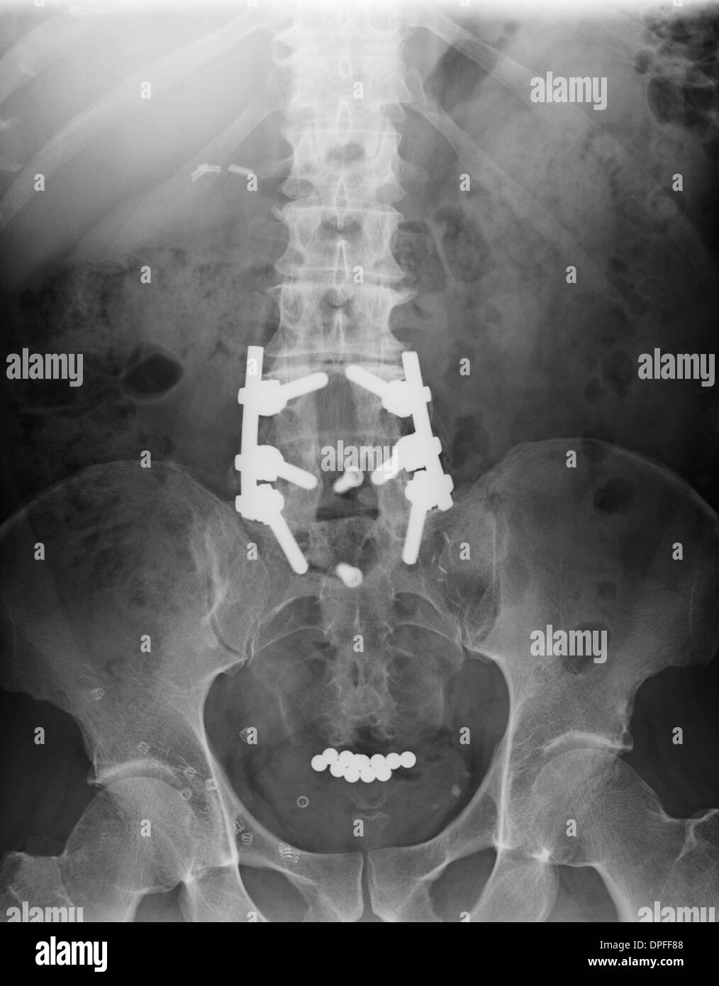 Xray zeigt Spondylodese und Objekte in der Blase Stockfotografie Alamy