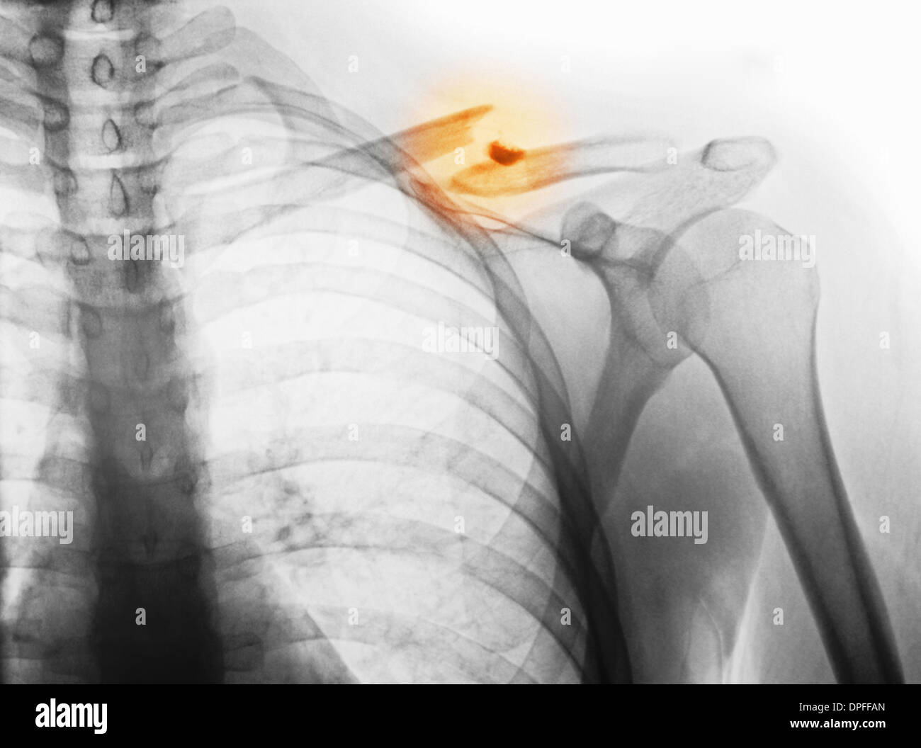 x-ray zeigt gebrochenen Schlüsselbein Stockfoto