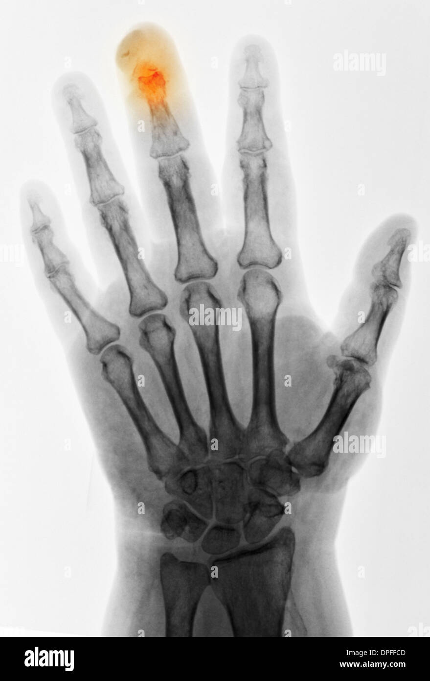 Hand Röntgen der Osteomyelitis bei einer diabetischen Frau Stockfoto