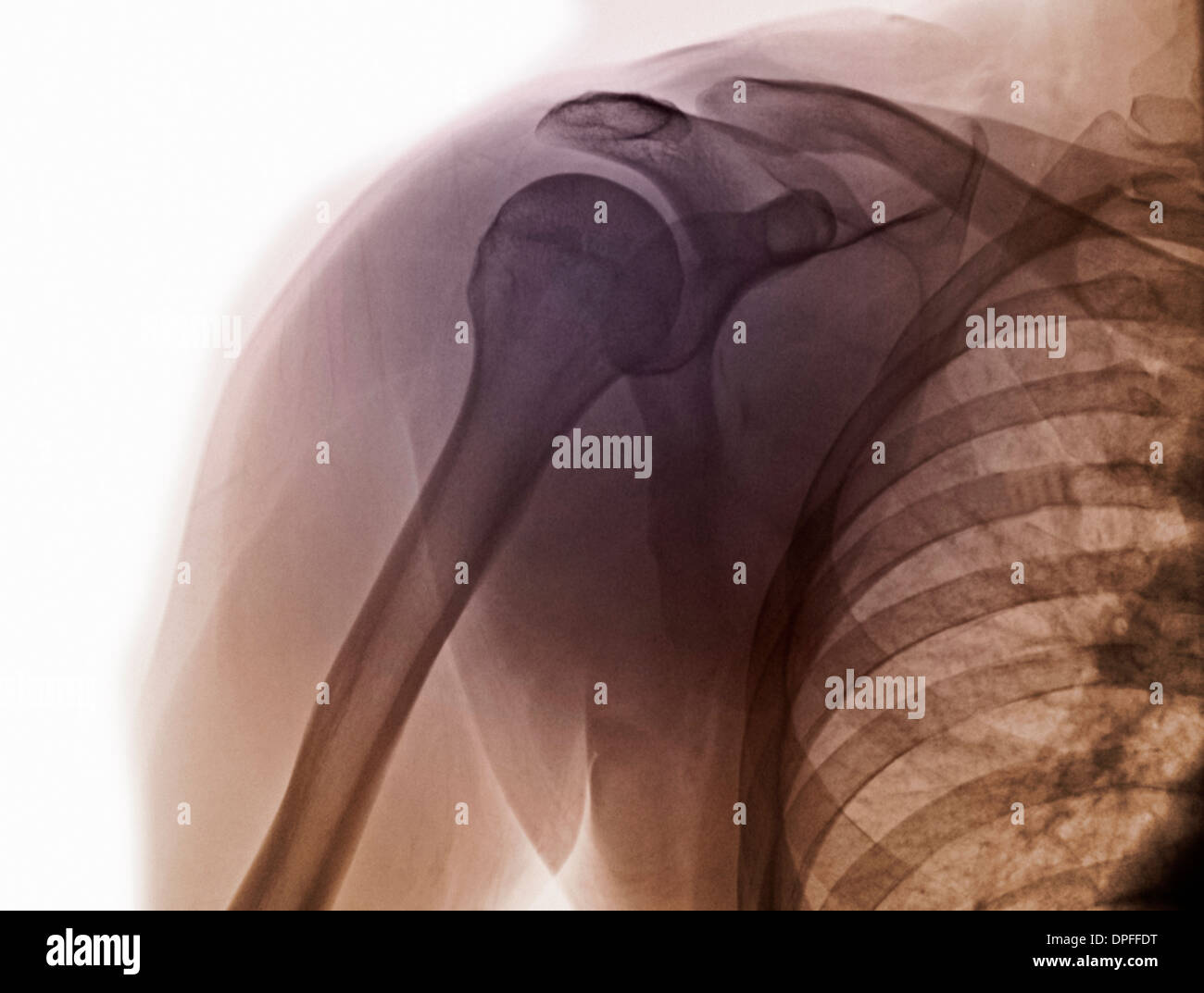 normale Schulter Röntgen Stockfoto