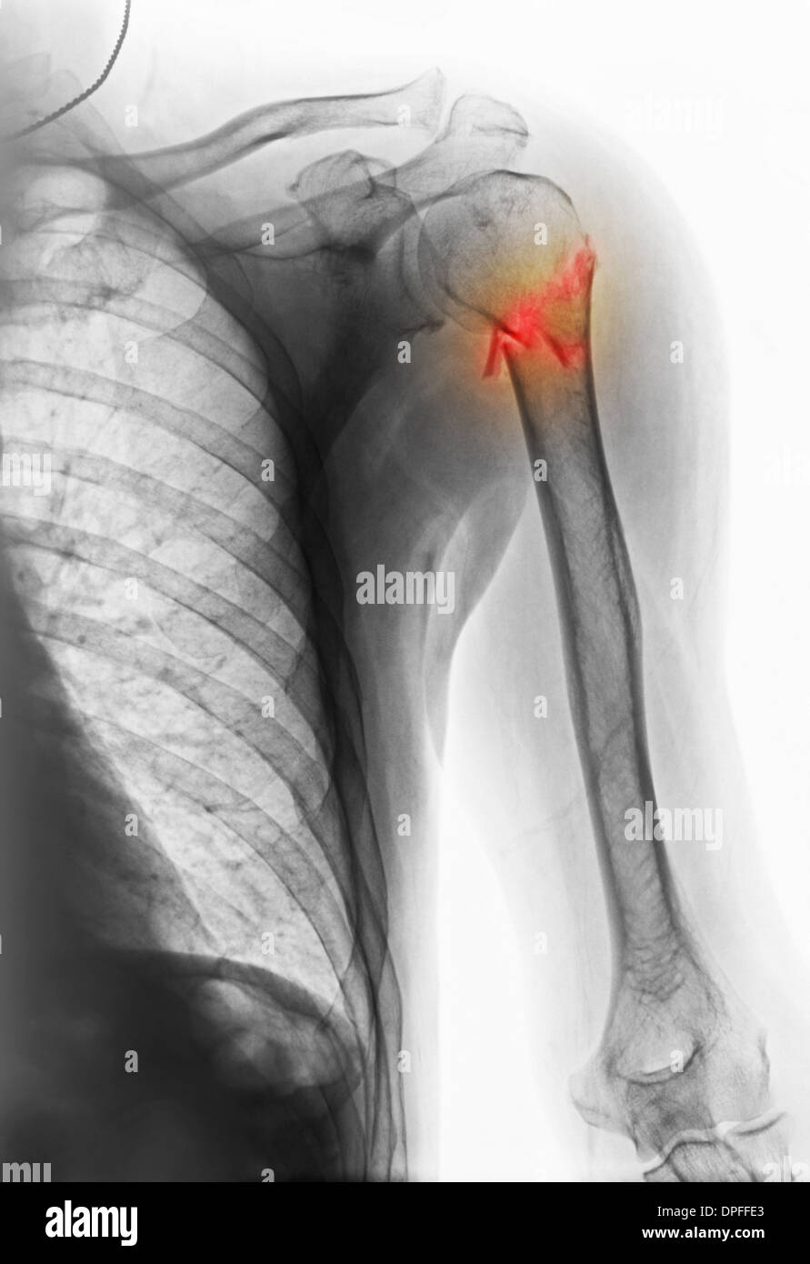 x-ray zeigt Fraktur des humerus Stockfoto