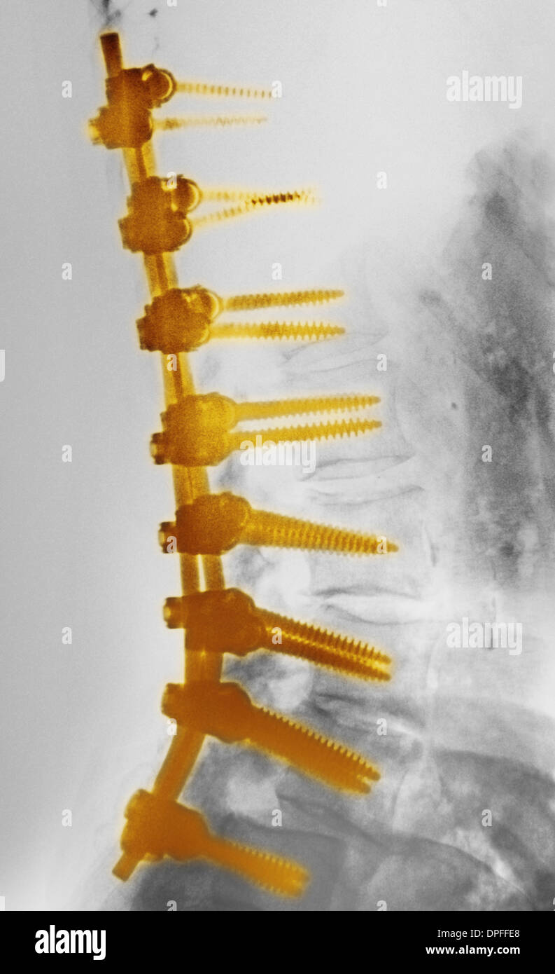 Röntgenaufnahme der Lendenwirbelsäule zeigt Spondylodese Stockfoto