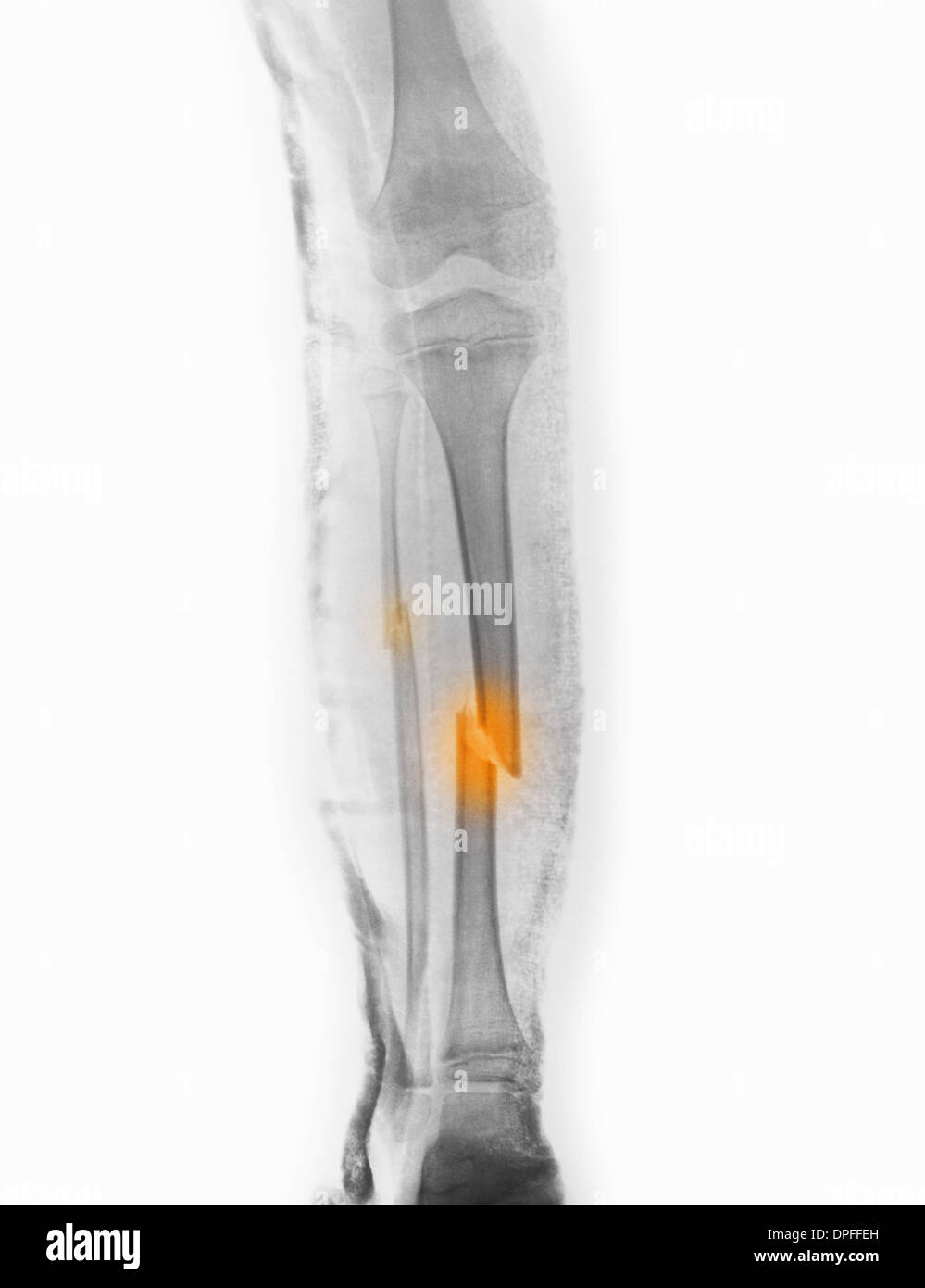x-ray zeigt schien- und Wadenbein Fraktur Stockfotografie - Alamy