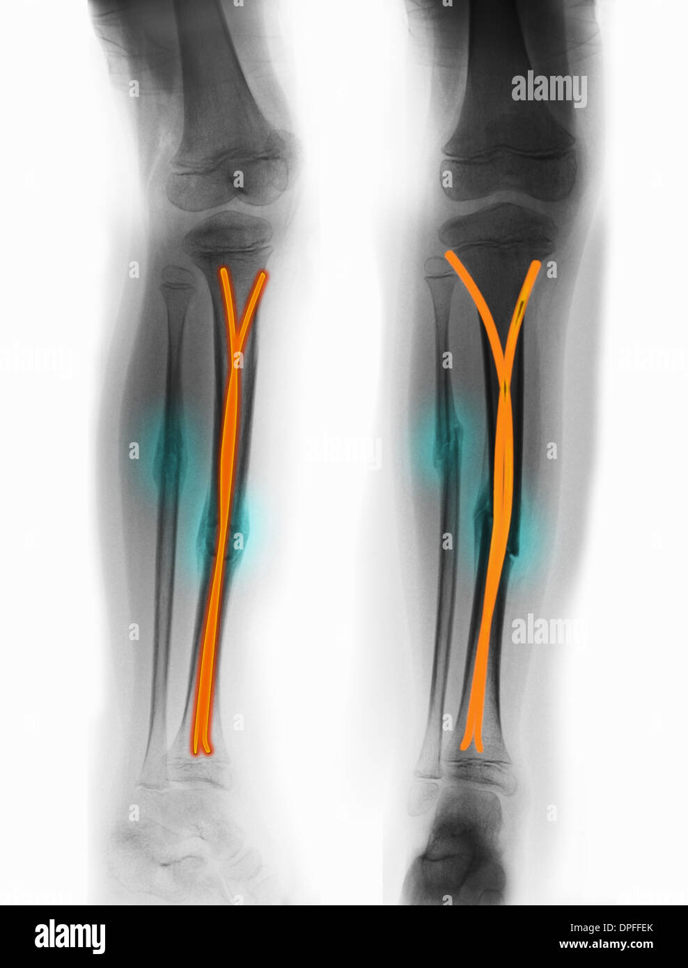 x-ray zeigt schien- und Wadenbein Fraktur Stockfoto