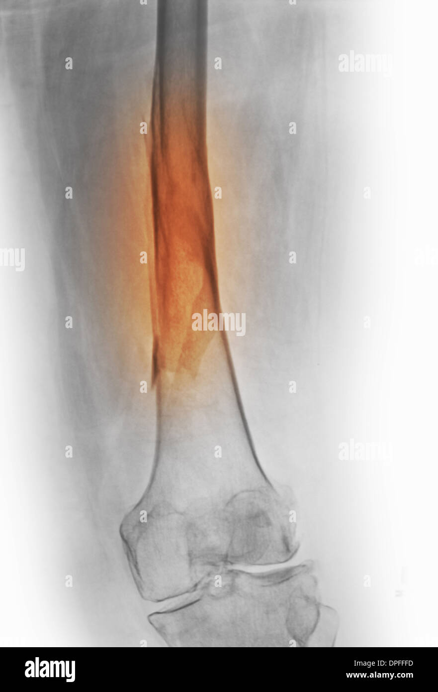 Röntgenbild einer Femur Fraktur Stockfoto