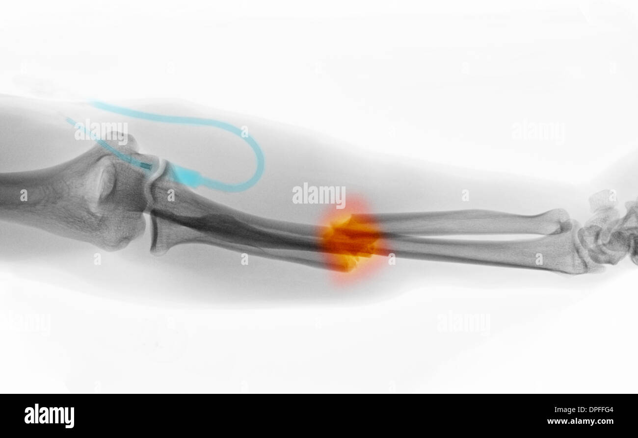 Ulna gebrochen -Fotos und -Bildmaterial in hoher Auflösung – Alamy