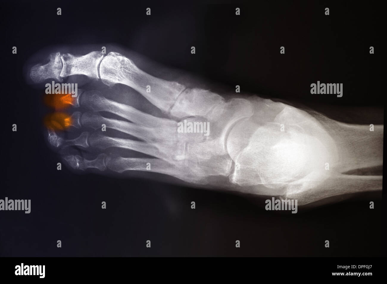Diabetischer fuss -Fotos und -Bildmaterial in hoher Auflösung – Alamy