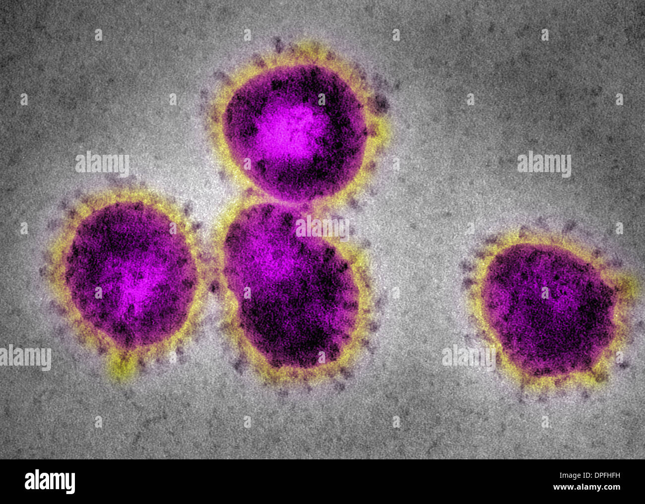 EM-Corona-Virus, verursacht SARS Stockfoto